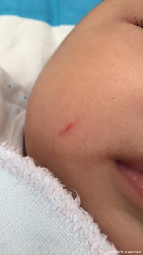 新生儿脸上抓破涂什么-第3张图片-郑州医学网