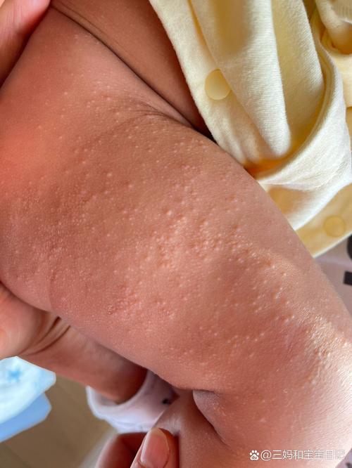 新生儿腿上长了小白点-第1张图片-郑州医学网