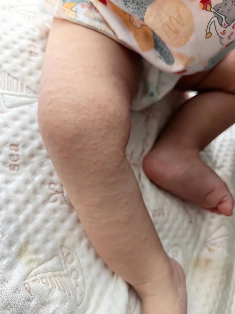 新生儿腿上长了小白点-第2张图片-郑州医学网
