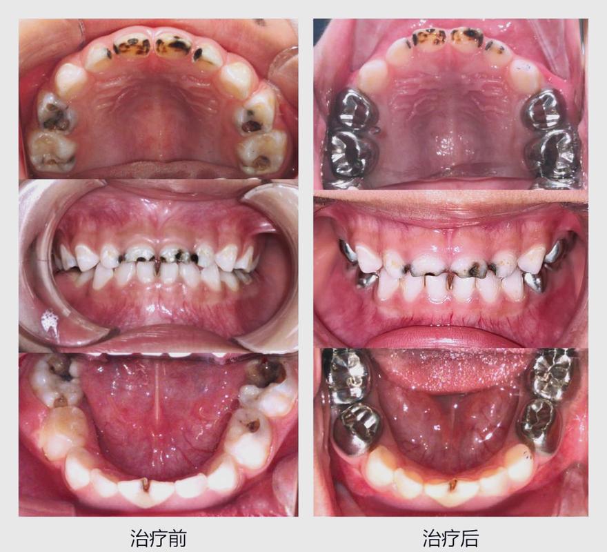 全麻补牙会对儿童的身体发育和认知功能产生哪些潜在影响？-第1张图片-郑州医学网