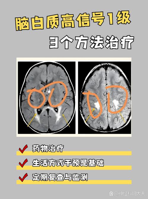 新生儿脑白质损伤的分级标准具体有哪些？不同级别损伤对患儿预后有何影响？-第1张图片-郑州医学网