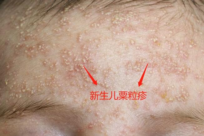 新生儿脸上的白色米粒是什么？需要处理吗？会自己消失吗？-第1张图片-郑州医学网