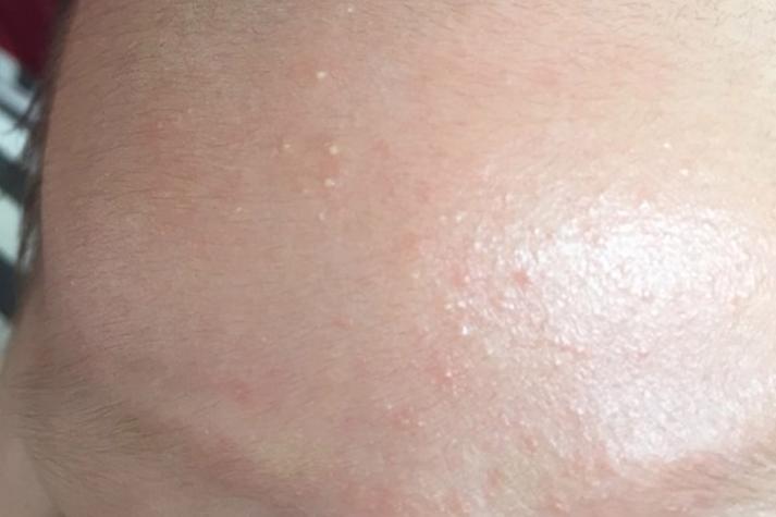 新生儿脸上的白色米粒是什么？需要处理吗？会自己消失吗？-第2张图片-郑州医学网