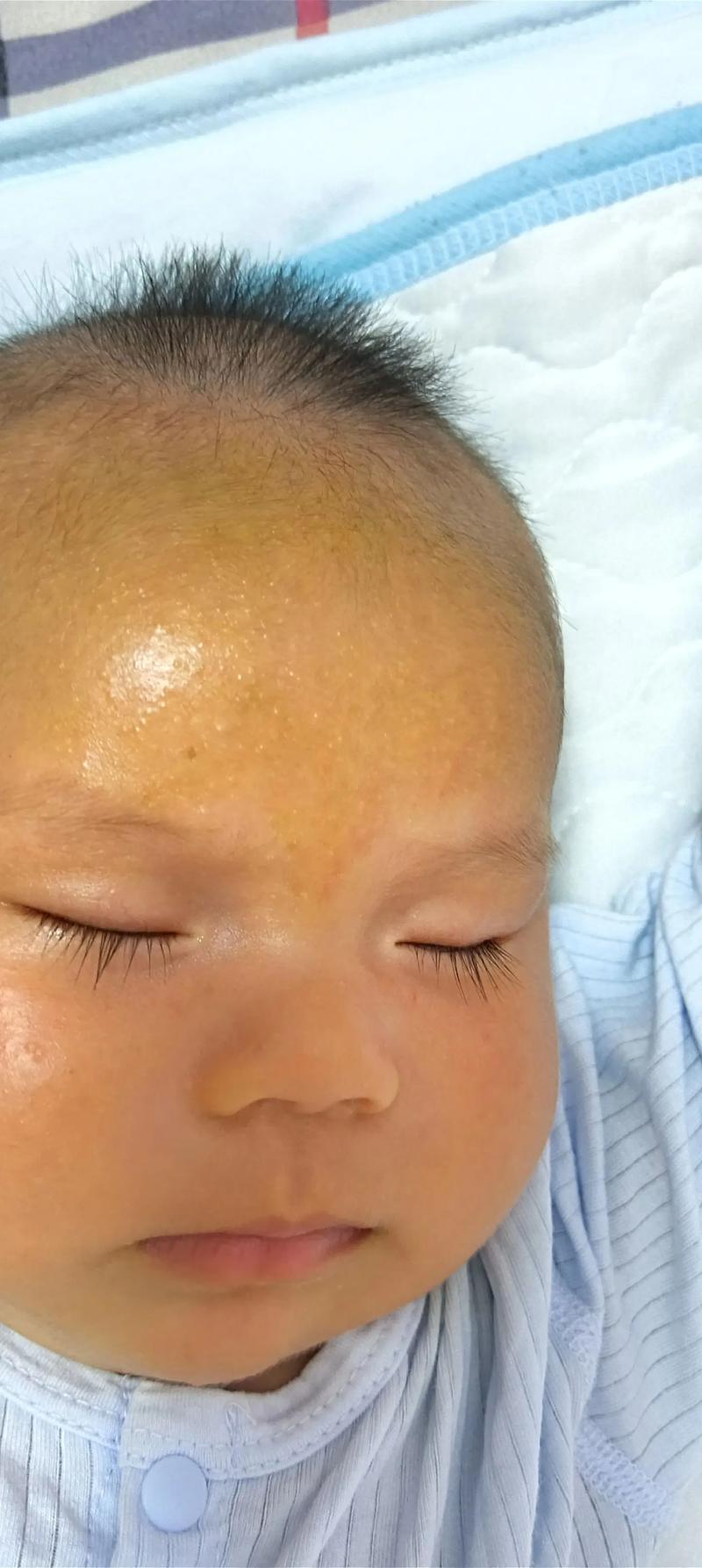 新生儿额头白色颗粒是正常现象吗？需要特别处理吗？-第1张图片-郑州医学网