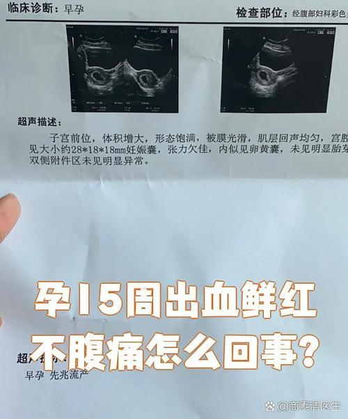 怀孕期间息肉持续出血，对胎儿有影响吗？需要立即处理吗？-第3张图片-郑州医学网
