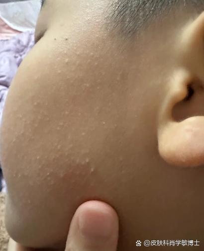 儿童脸颊两侧长小颗粒是湿疹还是过敏？需要治疗吗？-第1张图片-郑州医学网