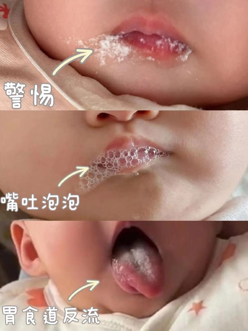 新生儿肺炎出院后吐泡泡是正常现象还是病情反复?-第2张图片-郑州医学网 新生儿肺炎出院后吐泡泡是正常现象还是病情反复?-第2张图片-郑州医学网