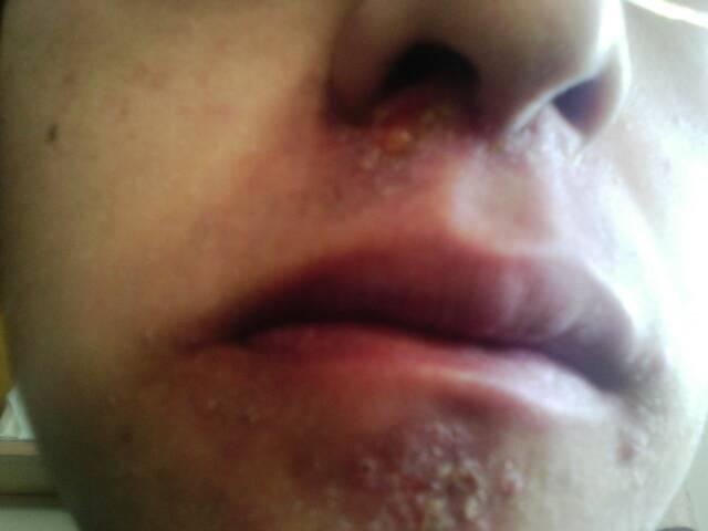 新生儿头皮红色疙瘩是湿疹还是毛囊炎?该怎么护理才好?-第2张图片-郑州医学网 新生儿头皮红色疙瘩是湿疹还是毛囊炎?该怎么护理才好?-第2张图片-郑州医学网