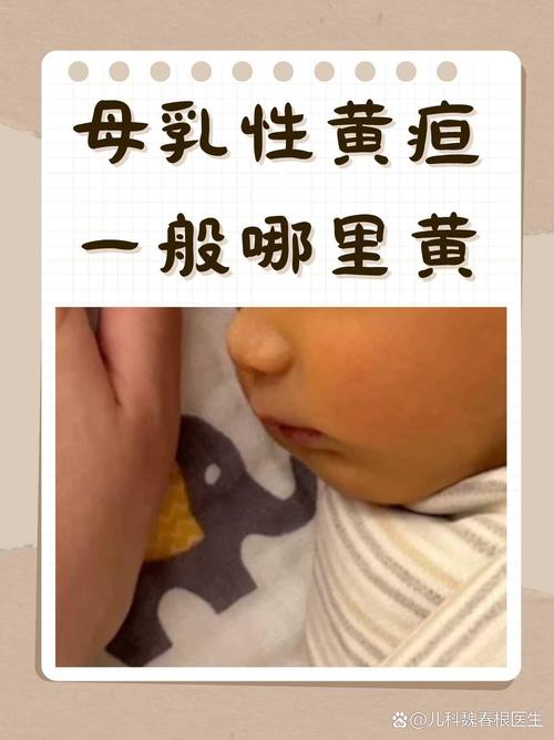 新生儿黄疸不能母乳吗-第1张图片-郑州医学网