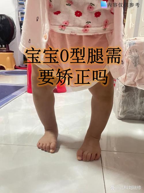 儿童腿型发育标准图片如何准确判断不同年龄段的正常与异常?-第1张图片-郑州医学网 儿童腿型发育标准图片如何准确判断不同年龄段的正常与异常?-第1张图片-郑州医学网