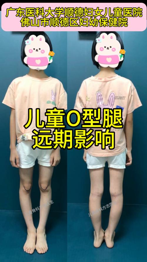儿童腿型发育标准图片如何准确判断不同年龄段的正常与异常？-第2张图片-郑州医学网