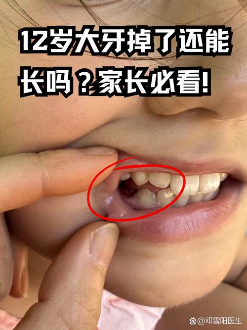 儿童双排牙到底该不该拔？不拔会自行替换吗？有哪些危害？-第2张图片-郑州医学网