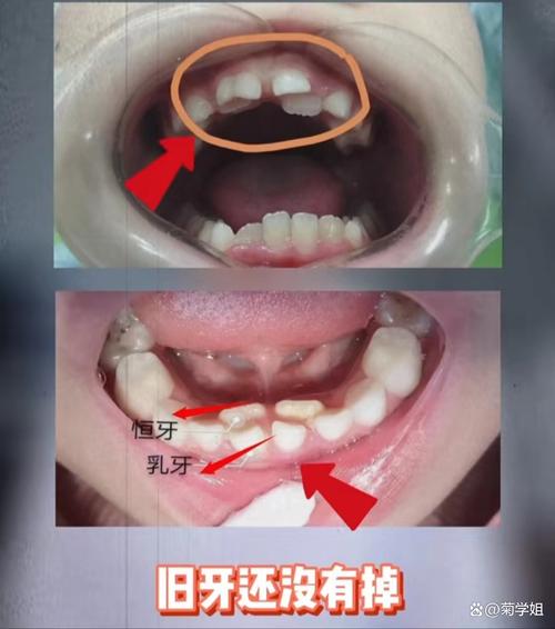 儿童双排牙到底该不该拔？不拔会自行替换吗？有哪些危害？-第1张图片-郑州医学网