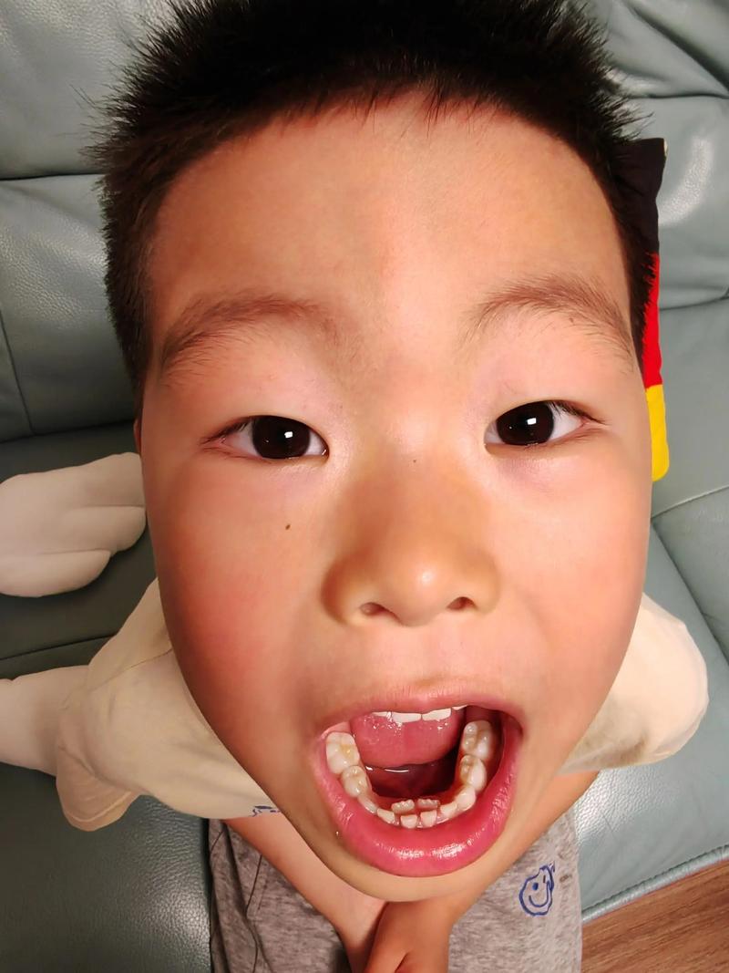 儿童双排牙到底该不该拔？不拔会自行替换吗？有哪些危害？-第3张图片-郑州医学网