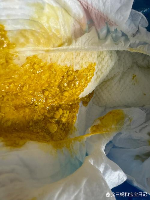 新生儿频繁拉一点点屎是正常生理现象还是消化异常信号?-第1张图片-郑州医学网 新生儿频繁拉一点点屎是正常生理现象还是消化异常信号?-第1张图片-郑州医学网