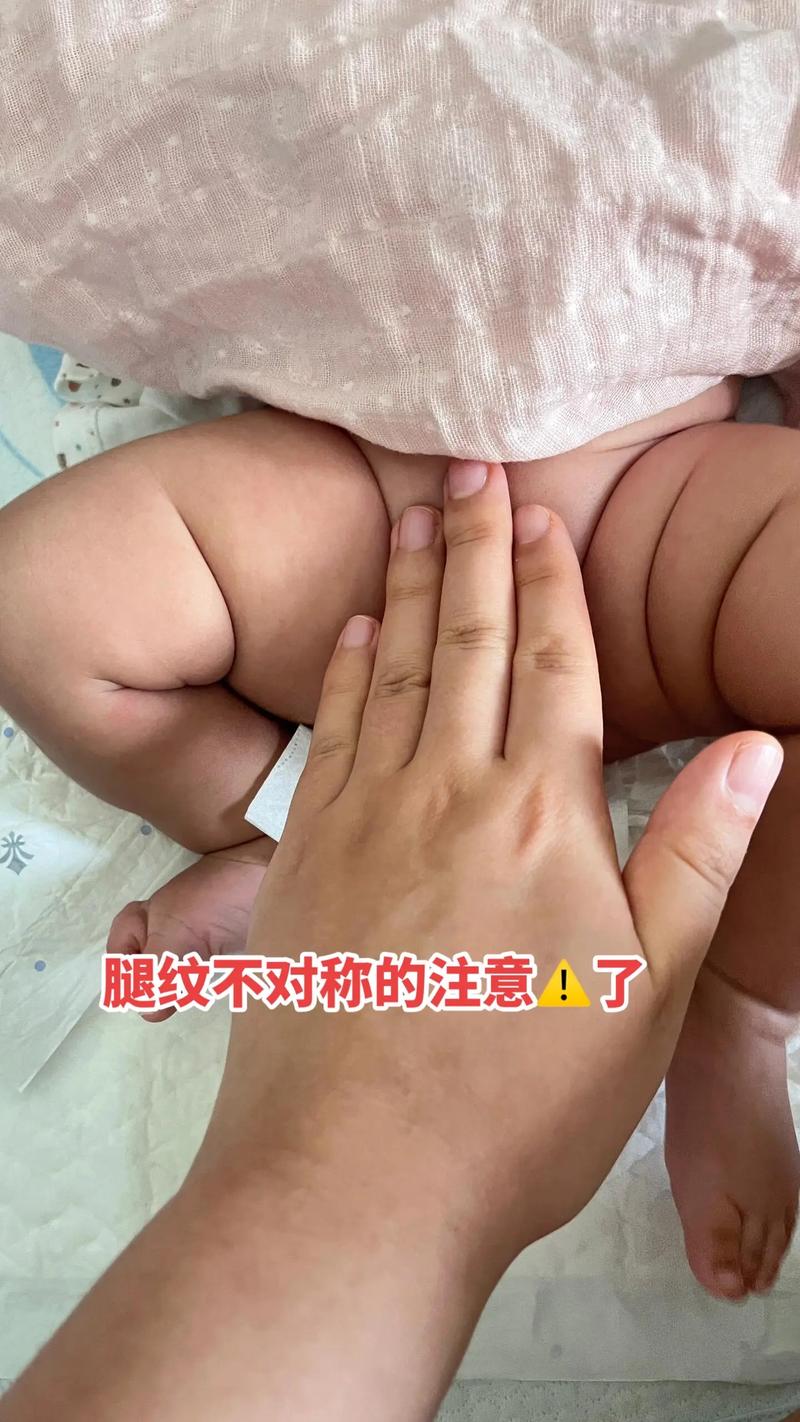 新生儿左右腿不一样粗是正常现象还是发育异常？需要警惕哪些潜在问题？-第2张图片-郑州医学网