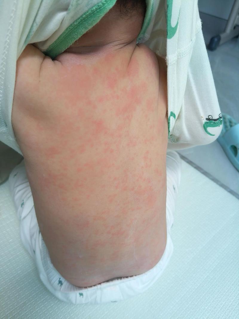 儿童退烧三天后为何再次发烧？是反复感染还是疾病未愈？-第1张图片-郑州医学网