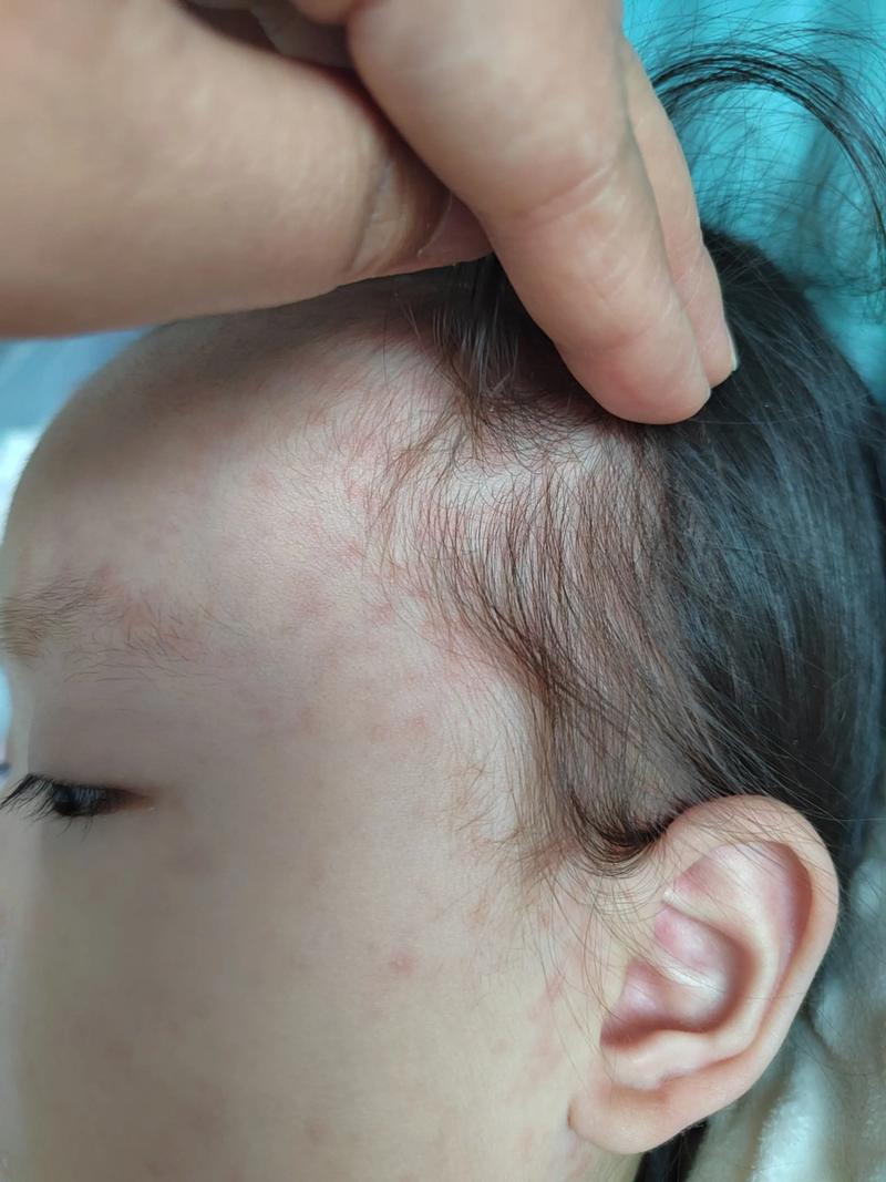 儿童退烧三天后为何再次发烧？是反复感染还是疾病未愈？-第3张图片-郑州医学网