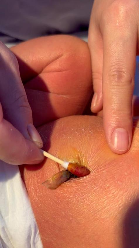 孕期肚脐清洁该用碘伏吗？对胎儿有影响吗？-第3张图片-郑州医学网