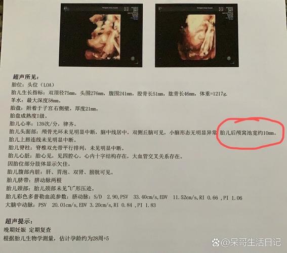 新生儿后颅窝池正常值范围是多少？不同孕周有何变化？异常情况如何识别？-第1张图片-郑州医学网