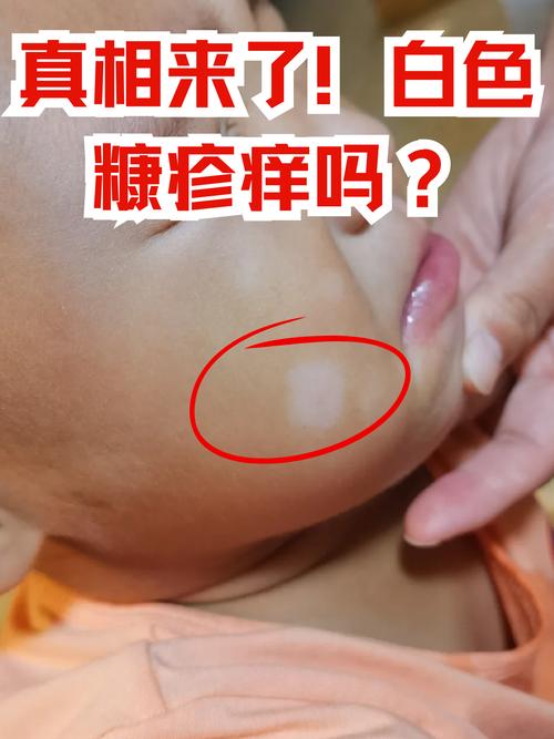 儿童脸上白色糠疹图片是哪种皮肤病？需要治疗吗？-第2张图片-郑州医学网