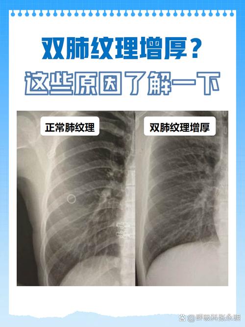 儿童双肺纹理增重模糊是肺炎吗?需要做哪些检查?-第2张图片-郑州医学网 儿童双肺纹理增重模糊是肺炎吗?需要做哪些检查?-第2张图片-郑州医学网