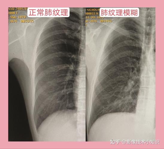 儿童双肺纹理增重模糊是肺炎吗？需要做哪些检查？-第3张图片-郑州医学网