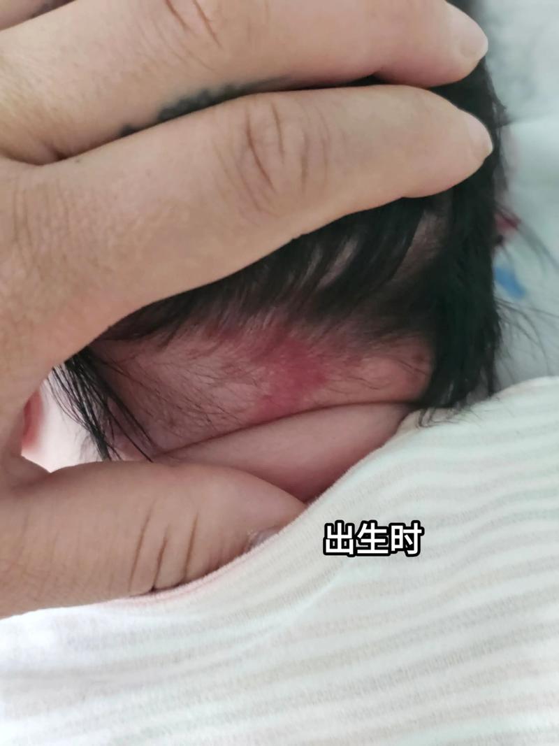 新生儿鼻翼两侧有红印-第1张图片-郑州医学网