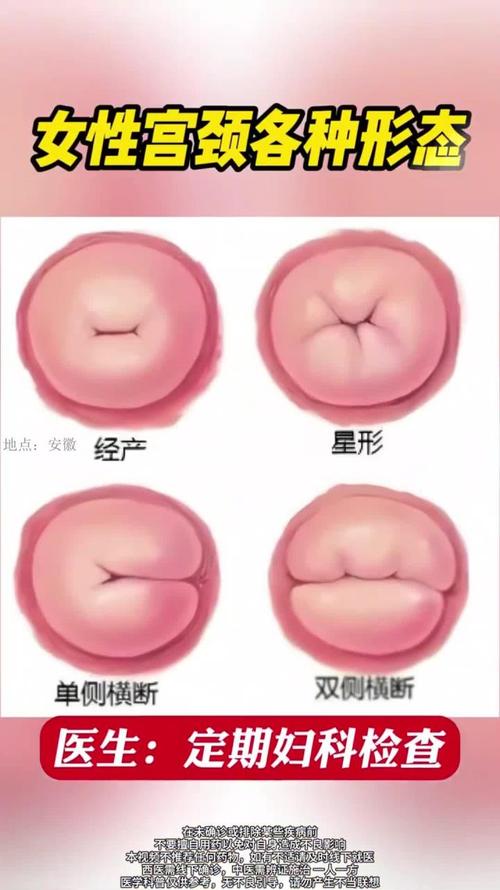 孕期宫颈短会长上去吗-第3张图片-郑州医学网