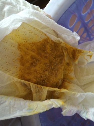 新生儿一天大便20次是正常现象还是健康警报？-第3张图片-郑州医学网