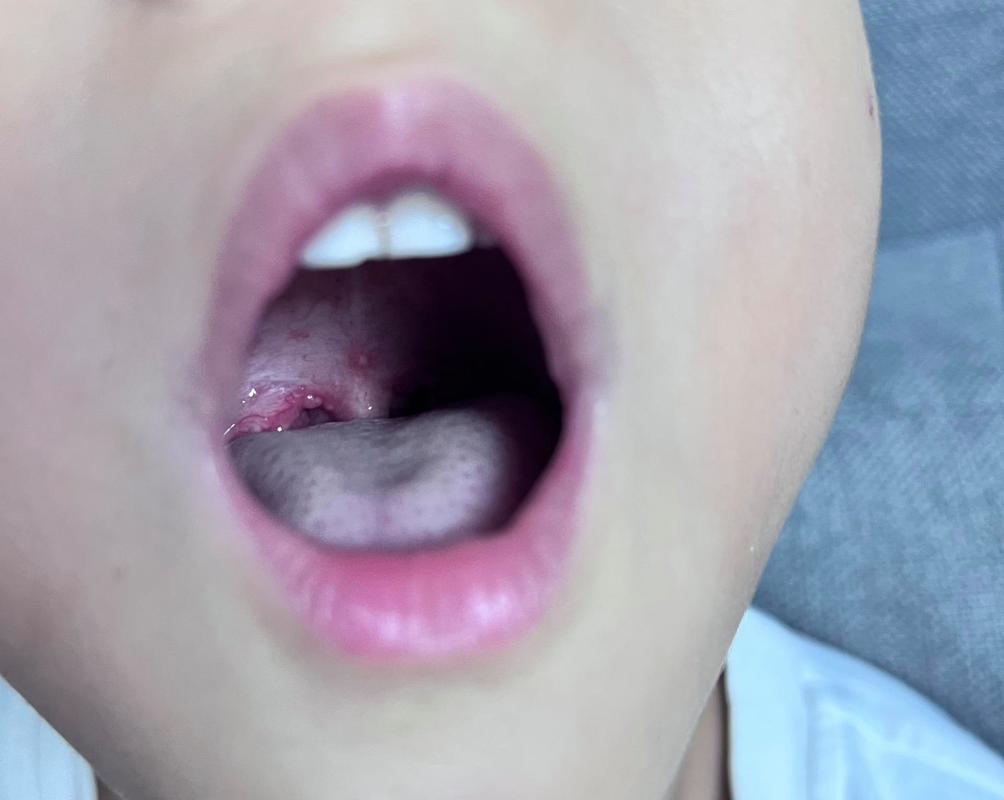 儿童嗓子化脓发烧一般几天能退烧？如何判断是否需要就医？-第2张图片-郑州医学网