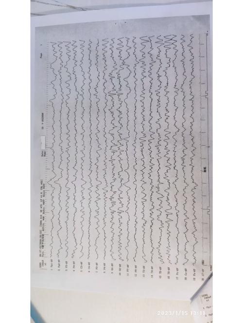 什么是视频儿童脑电图-第1张图片-郑州医学网 什么是视频儿童脑电图-第1张图片-郑州医学网