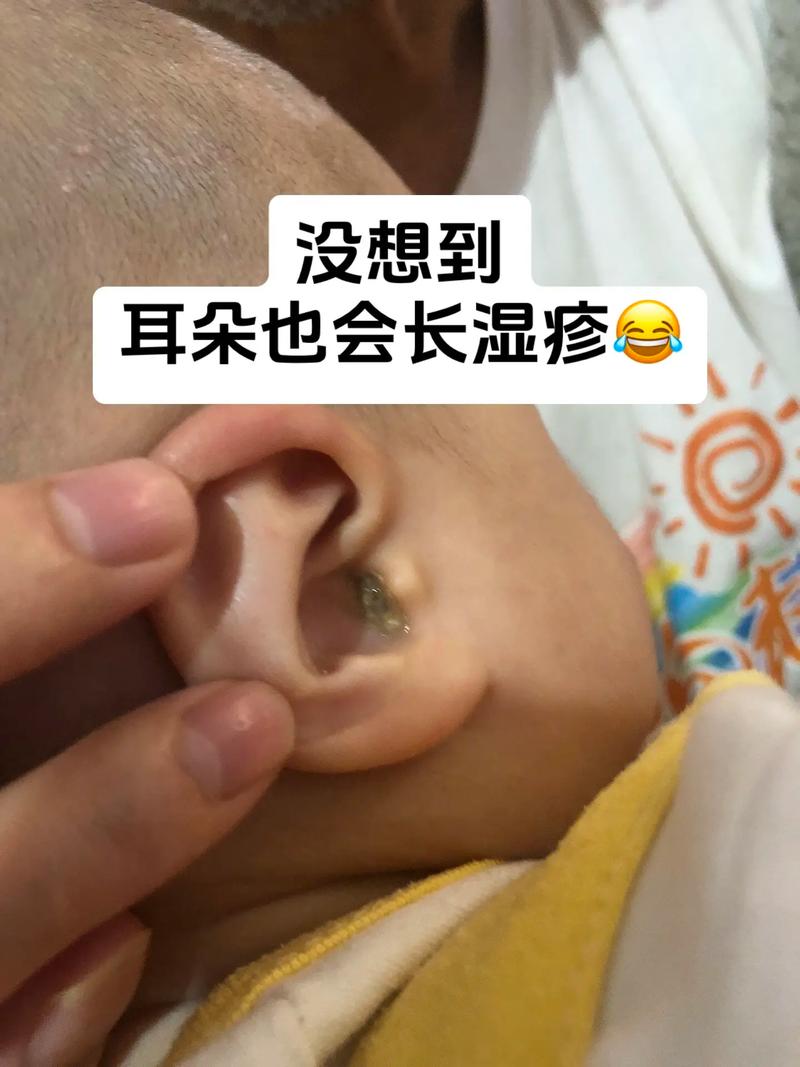 新生儿一只耳朵流黄水-第1张图片-郑州医学网 新生儿一只耳朵流黄水-第1张图片-郑州医学网