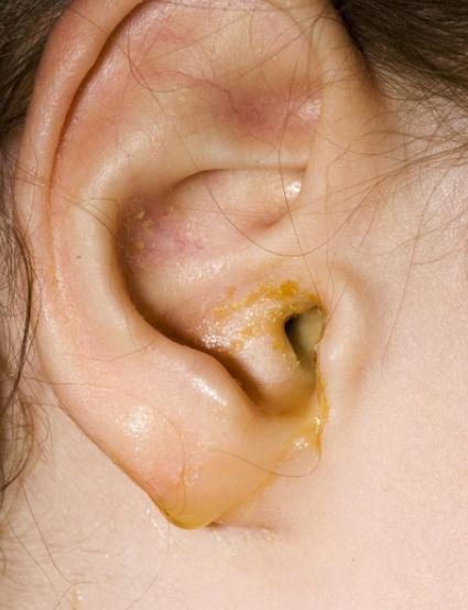 新生儿一只耳朵流黄水-第2张图片-郑州医学网 新生儿一只耳朵流黄水-第2张图片-郑州医学网