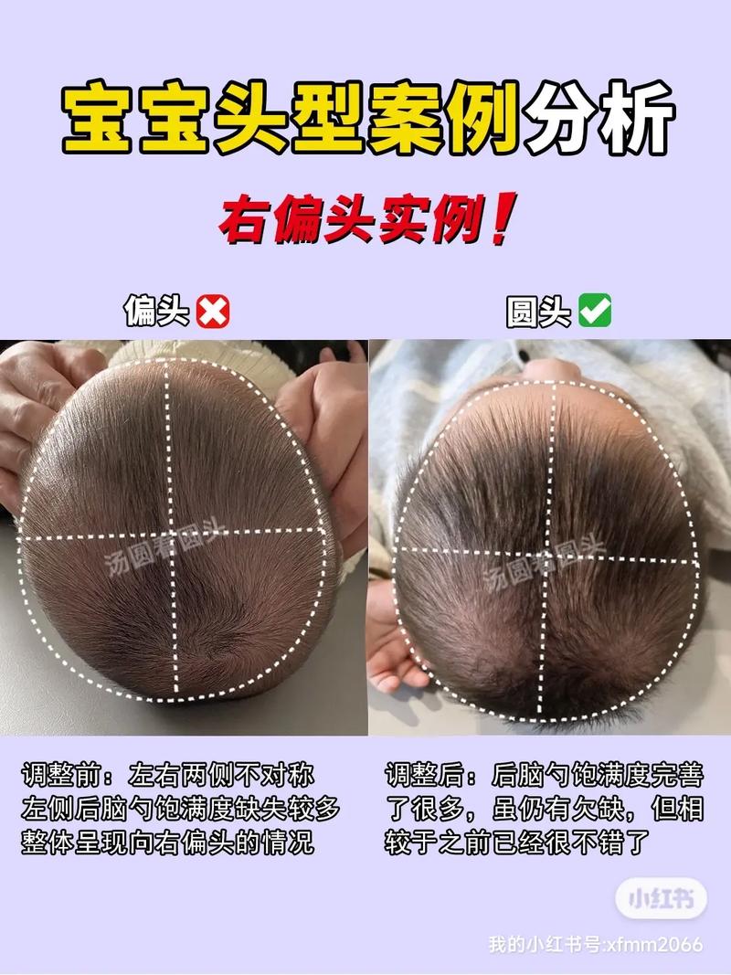 新生儿头总偏向一边睡,是正常习惯还是需要警惕的斜颈信号?-第3张图片-郑州医学网 新生儿头总偏向一边睡,是正常习惯还是需要警惕的斜颈信号?-第3张图片-郑州医学网