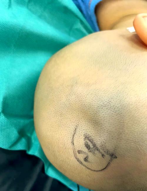 新生儿头部被砸后，家长该如何判断是否需要就医？有哪些异常症状需警惕？-第1张图片-郑州医学网