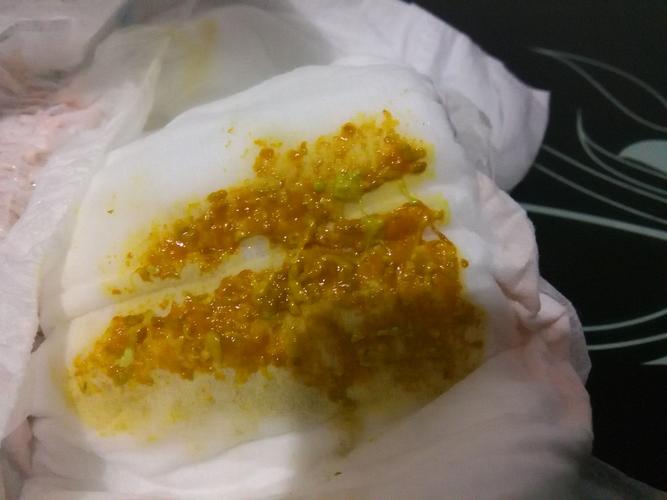 新生儿大便呈一粒粒状是正常还是异常?需要警惕哪些健康问题?-第1张图片-郑州医学网 新生儿大便呈一粒粒状是正常还是异常?需要警惕哪些健康问题?-第1张图片-郑州医学网