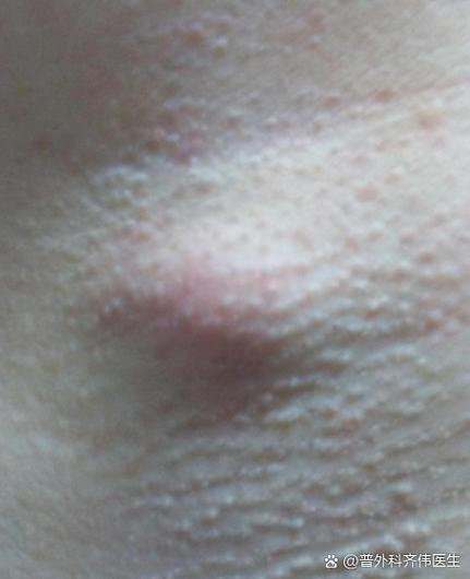 孕期腋下突然长两个疙瘩,是正常生理变化还是疾病信号?-第1张图片-郑州医学网 孕期腋下突然长两个疙瘩,是正常生理变化还是疾病信号?-第1张图片-郑州医学网