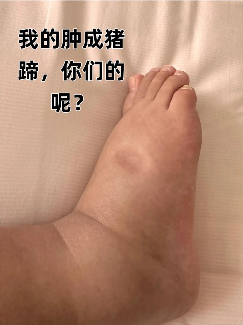 孕期水肿是否会引起手麻?背后的神经压迫机制是什么?-第1张图片-郑州医学网 孕期水肿是否会引起手麻?背后的神经压迫机制是什么?-第1张图片-郑州医学网