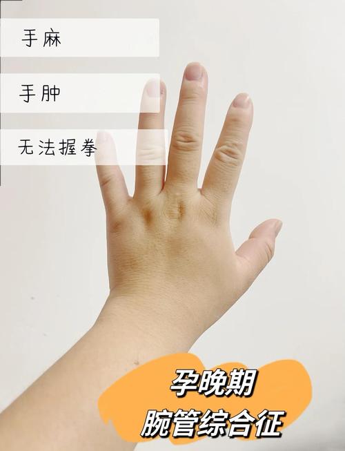 孕期水肿是否会引起手麻？背后的神经压迫机制是什么？-第3张图片-郑州医学网