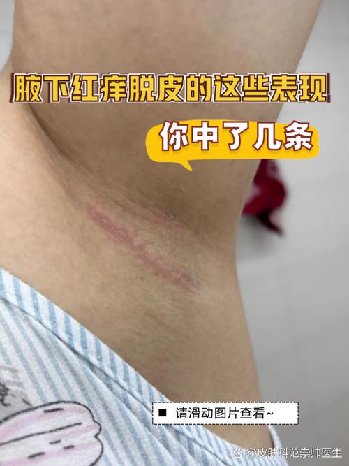 孕期腋窝瘙痒难耐？是激素变化还是皮肤问题在作祟？-第1张图片-郑州医学网