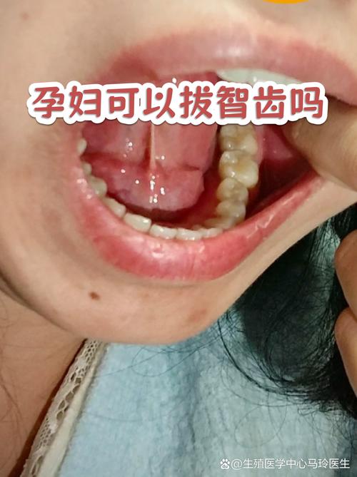 孕期拔牙为何禁忌？孕期口腔治疗风险大，孕期牙痛怎么办？-第2张图片-郑州医学网