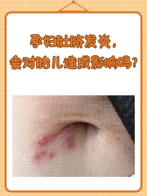 孕期肚脐眼周围皮肤疼，是正常现象还是需要警惕的异常信号？-第1张图片-郑州医学网