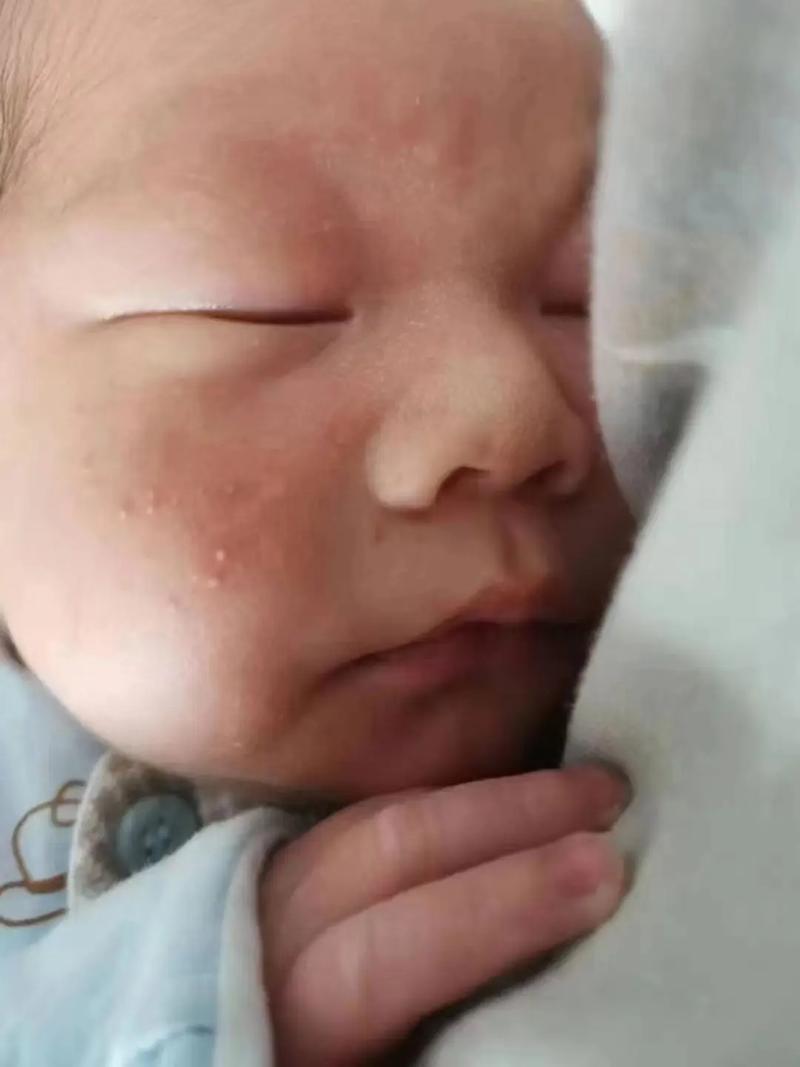 新生儿脸上有小红点点-第1张图片-郑州医学网 新生儿脸上有小红点点-第1张图片-郑州医学网