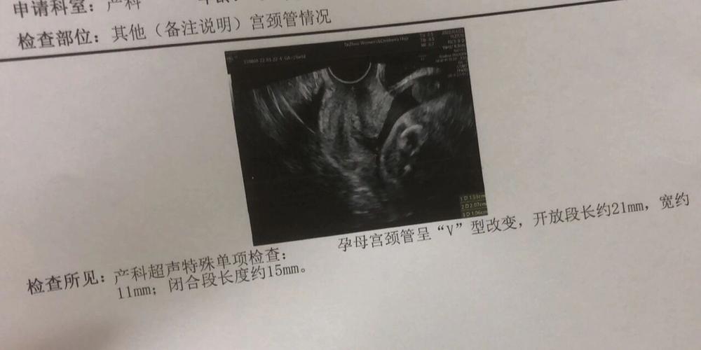 孕期宫颈管分离3mm需要紧张吗？会不会影响胎儿健康？-第1张图片-郑州医学网