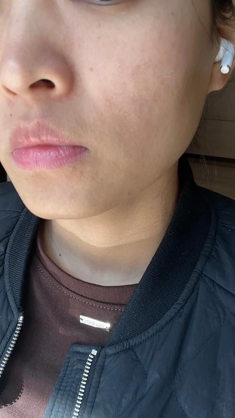 孕期脸上突然长红点，是孕期激素变化还是皮肤过敏？该怎么处理？-第1张图片-郑州医学网