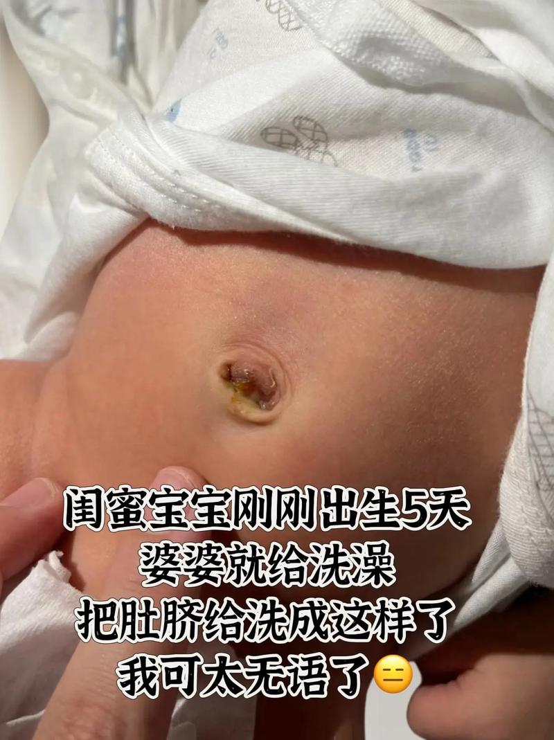 新生儿肚脐掉一半正常吗？需要处理还是等自然脱落？-第1张图片-郑州医学网