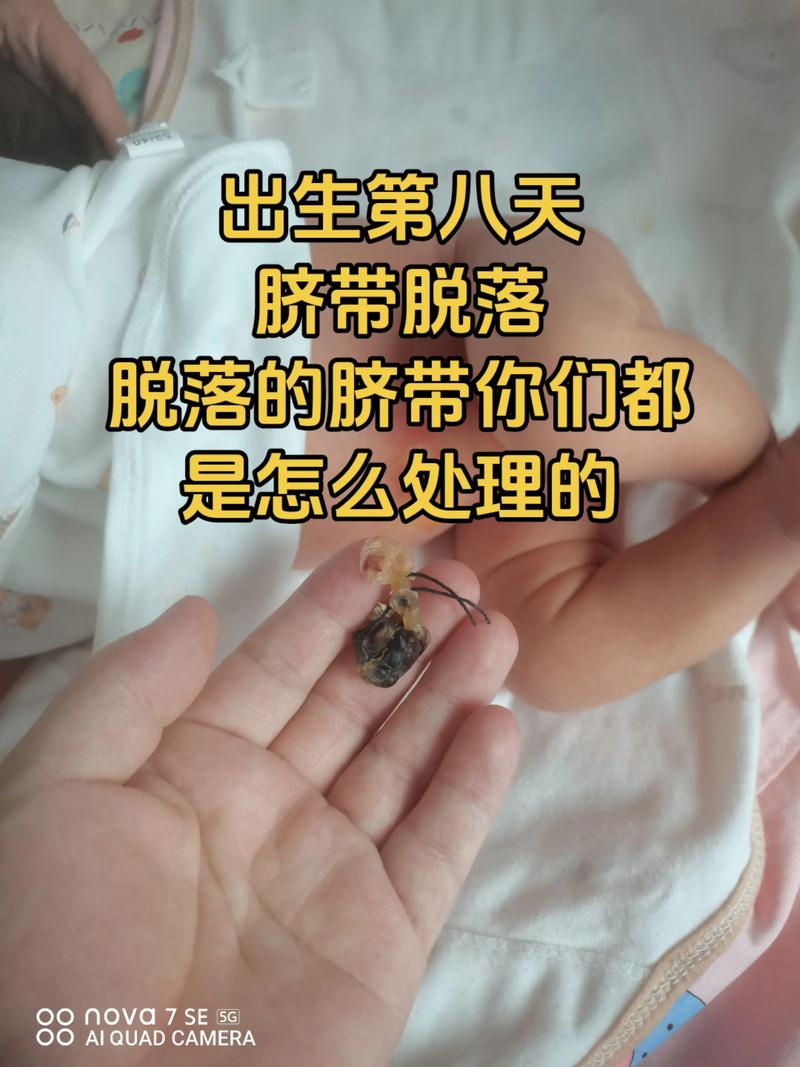 新生儿肚脐掉一半正常吗？需要处理还是等自然脱落？-第3张图片-郑州医学网