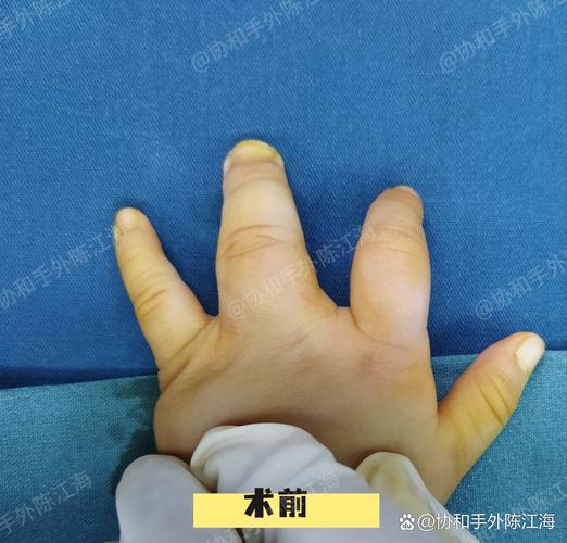 儿童手指畸形治疗，国内哪家医院在矫正技术与术后康复方面更权威？-第1张图片-郑州医学网