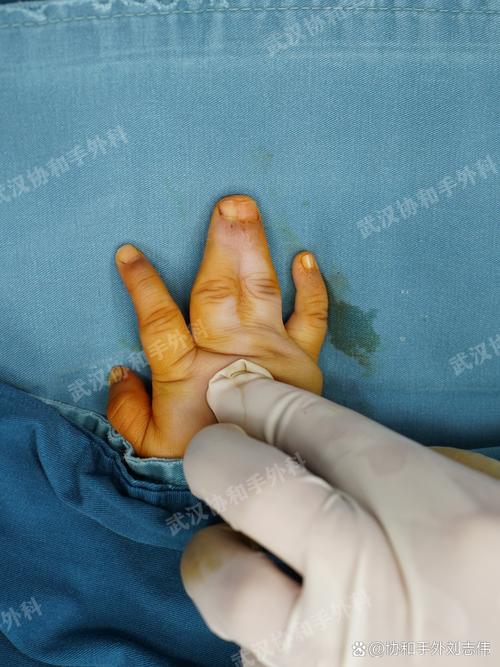 儿童手指畸形治疗，国内哪家医院在矫正技术与术后康复方面更权威？-第2张图片-郑州医学网